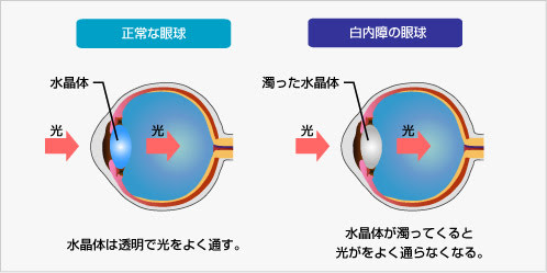 正常な眼球と白内障の眼球
